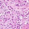 4A7 Astrocytoma, subependymal giant cell (SEGA Case 4) H&E 9.jpg