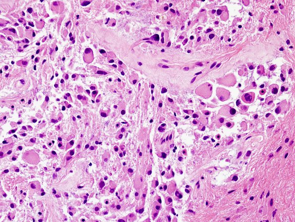 4A7 Astrocytoma, subependymal giant cell (SEGA Case 4) H&E 9.jpg