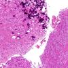 4A8 Astrocytoma, subependymal giant cell (SEGA Case 4) H&E 4.jpg