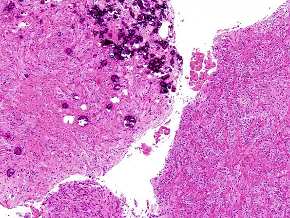 4A8 Astrocytoma, subependymal giant cell (SEGA Case 4) H&E 4.jpg