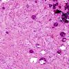 4A9 Astrocytoma, subependymal giant cell (SEGA Case 4) H&E 3.jpg