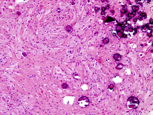 4A9 Astrocytoma, subependymal giant cell (SEGA Case 4) H&E 3.jpg