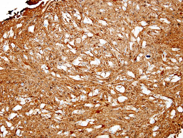 4B1 Astrocytoma, subependymal giant cell (SEGA Case 4 GFAP 3.jpg