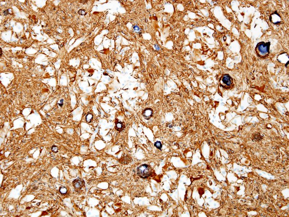 4B2 Astrocytoma, subependymal giant cell (SEGA Case 4) GFAP 4.jpg