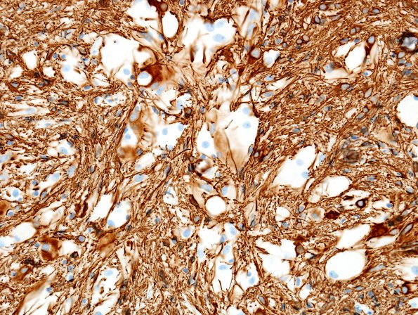 4B3 Astrocytoma, subependymal giant cell (SEGA Case 4) GFAP 1.jpg