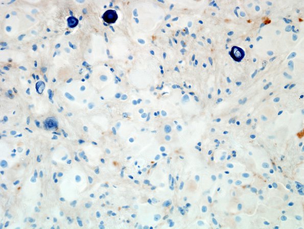 4C Astrocytoma, subependymal giant cell (SEGA Case 4) SYN.jpg