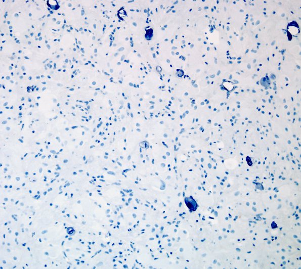 4F Astrocytoma, subependymal giant cell (SEGA Case 4) Ki67 4.jpg