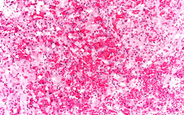 5A1 Subependymal Giant Cell Astrocytoma (SEGA, Case 5) H&E 20X