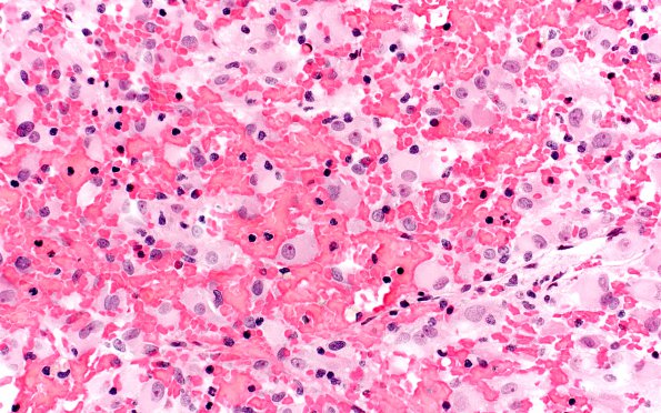 5A2 Subependymal Giant Cell Astrocytoma (SEGA, Case 5) H&E 40X