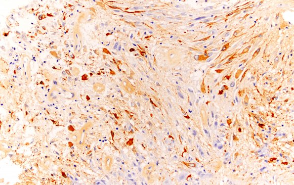 5B1 Subependymal Giant Cell Astrocytoma (SEGA, Case 5) GFAP 20X