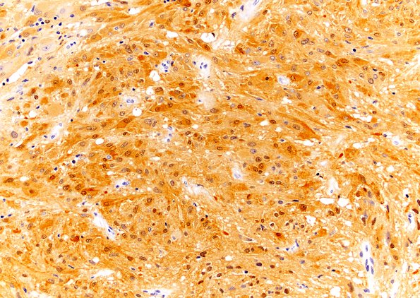 5B2 Subependymal Giant Cell Astrocytoma (SEGA, Case 5) S100 20X