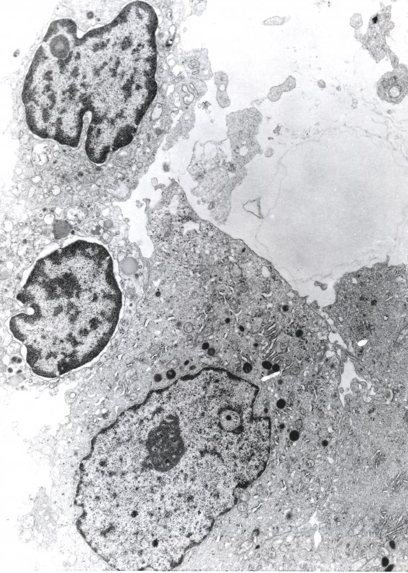 5C1 Subependymal Giant Cell Astrocytoma (SEGA, Case 5) EM 3 - Copy