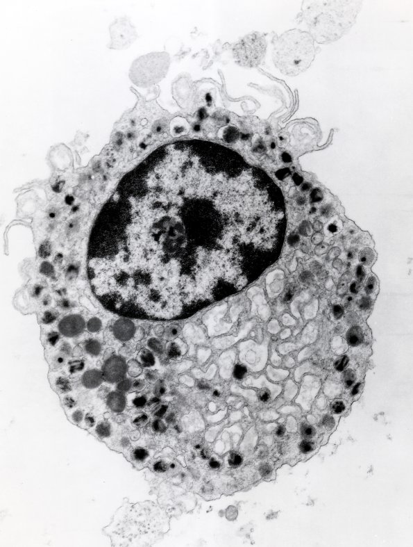 5C2 Subependymal Giant Cell Astrocytoma (SEGA, Case 5) EM 1 - Copy