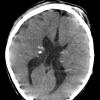 6A1 Subependymal Giant Cell Astrocytoma in TS (Case 6) CT - Copy