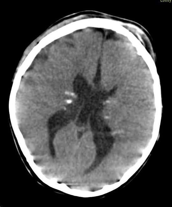 6A1 Subependymal Giant Cell Astrocytoma in TS (Case 6) CT - Copy