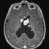 6A2 Subependymal Giant Cell Astrocytoma in TS (Case 6) T1W - Copy