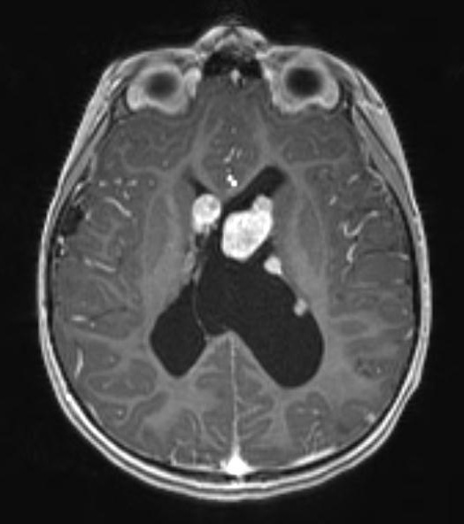 6A2 Subependymal Giant Cell Astrocytoma in TS (Case 6) T1W - Copy