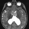 6A3 Subependymal Giant Cell Astrocytoma in TS (Case 6) T2 - Copy