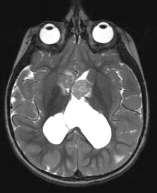 6A3 Subependymal Giant Cell Astrocytoma in TS (Case 6) T2 - Copy