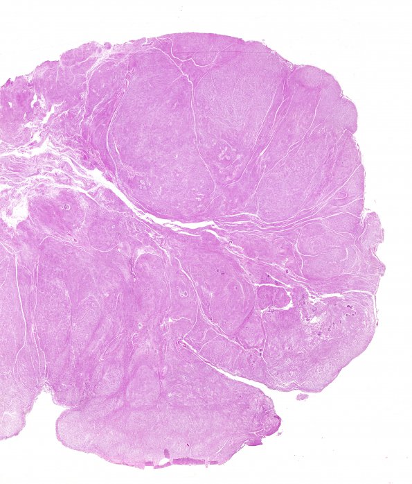 10A1 Subependymoma, CP Angle (AFIP TS M9665 set Slide 58, RES image) H&E 1A