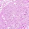 10A2 Subependymoma, CP Angle (AFIP TS M9665 set Slide 58, RES image) H&E 1