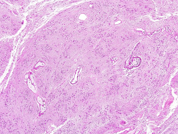 10A2 Subependymoma, CP Angle (AFIP TS M9665 set Slide 58, RES image) H&E 1