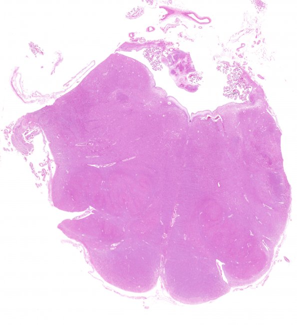 11A1 Subependymoma (Case 11) H&E whole mount