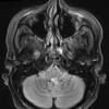 12A1 Subependymoma (S11-21513) TIRM BLADE - Copy