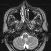 12A2 Subependymoma (S11-21513) T2 - Copy