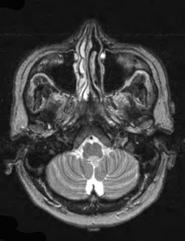 12A2 Subependymoma (S11-21513) T2 - Copy