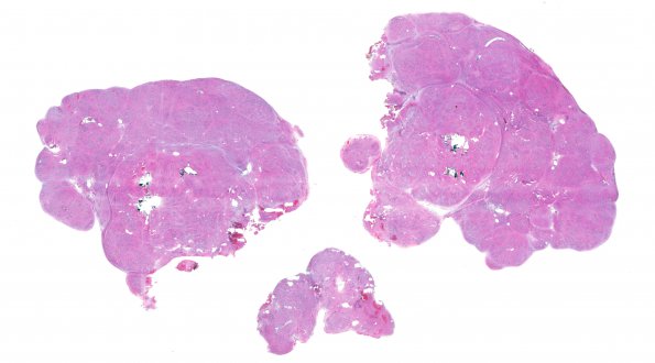 12B1 Subependymoma (Case 12) H&E whole mount 2