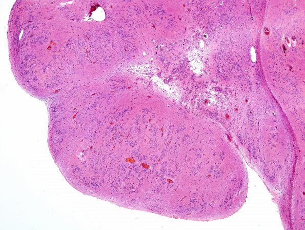 12B2 Subependymoma (Case 12) H&E 4