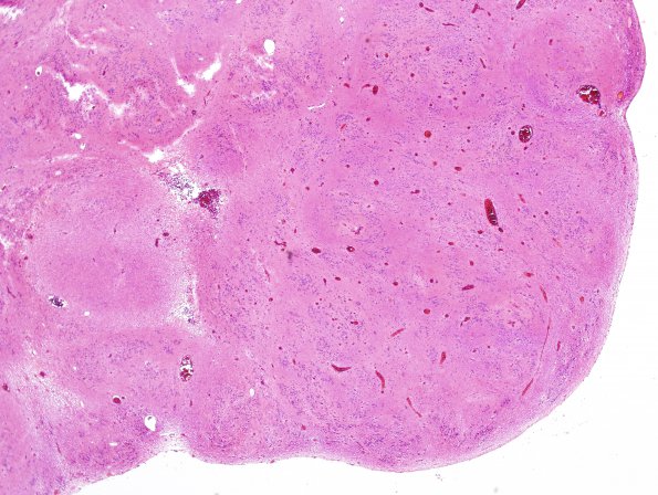 12B3 Subependymoma (Case 12) H&E 3