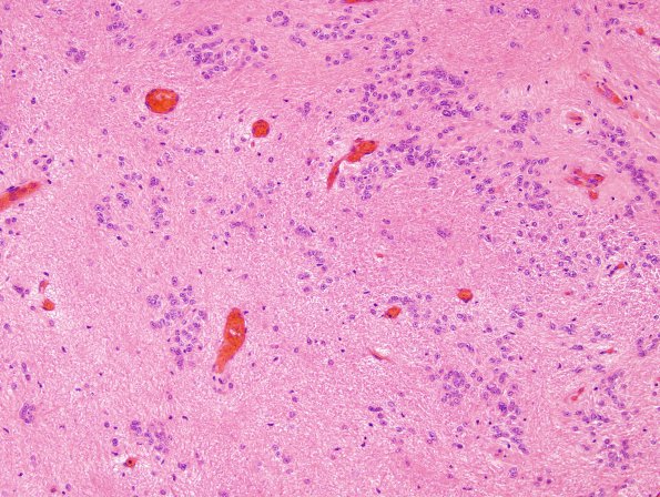 12B4 Subependymoma (Case 12) H&E 7