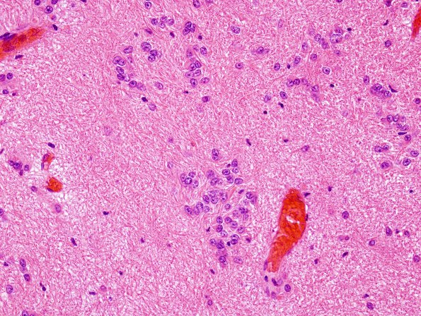 12B5 Subependymoma (Case 12) H&E 8