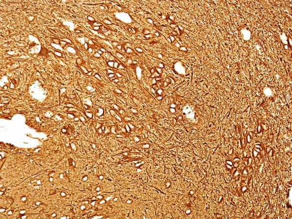 12C Subependymoma (Case 12) GFAP 1