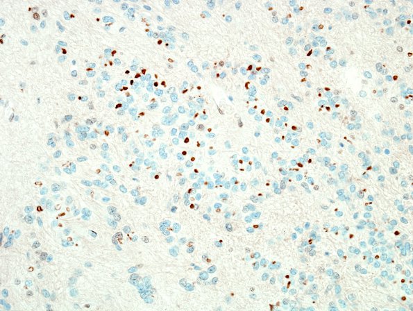 12D1 Subependymoma (Case 12) D2-40 1