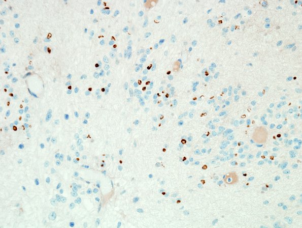 12D2 Subependymoma (Case 12) D2-40 2