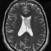 13A1 Subependymoma (Case 13) T2 1 - Copy