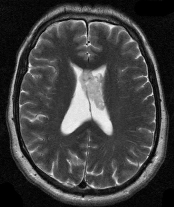 13A1 Subependymoma (Case 13) T2 1 - Copy