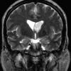 13A2 Subependymoma (Case 13) T2 2 - Copy