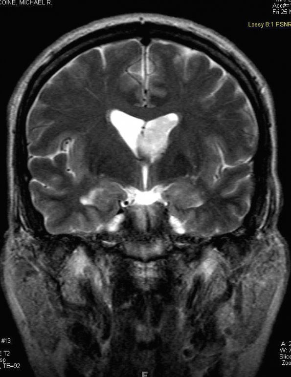 13A2 Subependymoma (Case 13) T2 2 - Copy