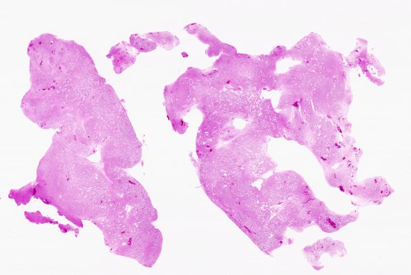 13B1 Subependymoma (Case 13) H&E whole mount