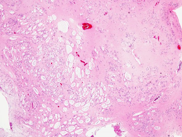 13B2 Subependymoma (Case 13) H&E 7