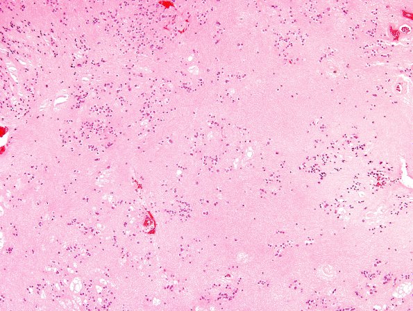 13B3 Subependymoma (Case 13) H&E 5