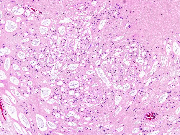 13B4 Subependymoma (Case 13) H&E 4