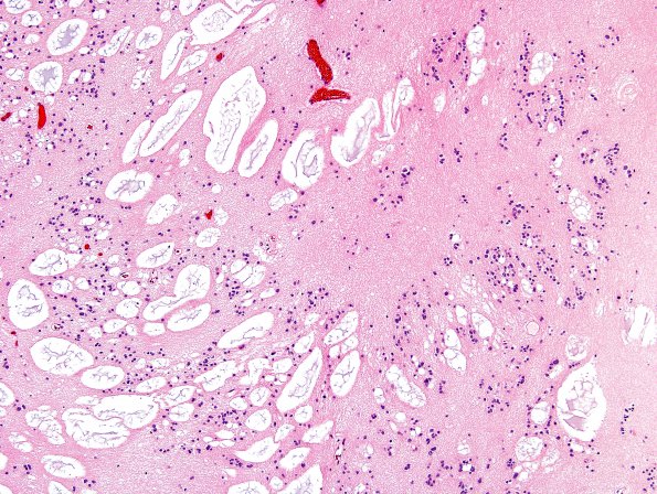 13B5 Subependymoma (Case 13) H&E 6