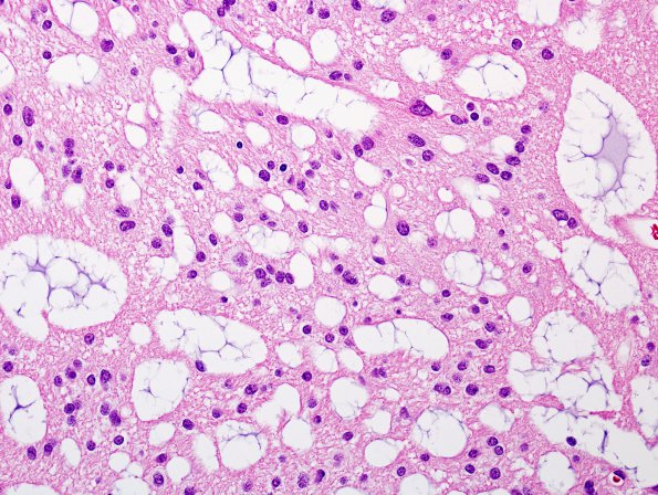 13B6 Subependymoma (Case 13) H&E 2