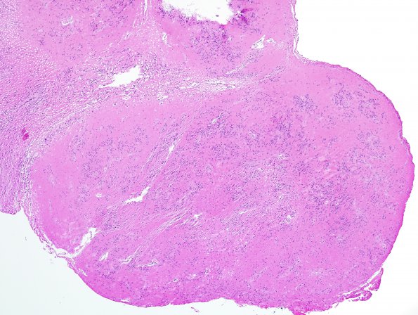 14A1 Subependymoma (Case 14) H&E 7