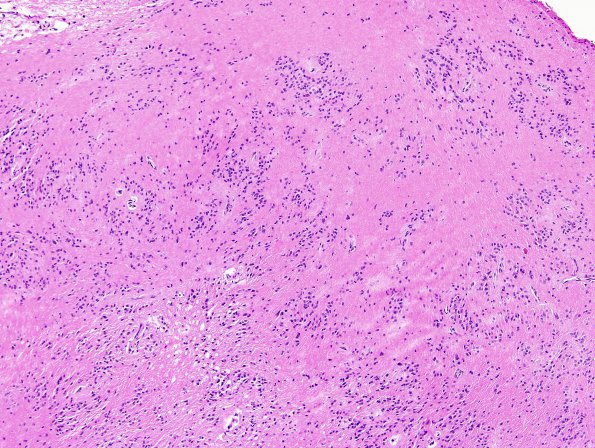 14A2 Subependymoma (W13-3516) H&E 6